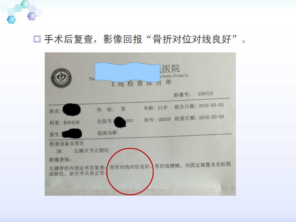 踝关节旋前外旋4度损伤病例讨论