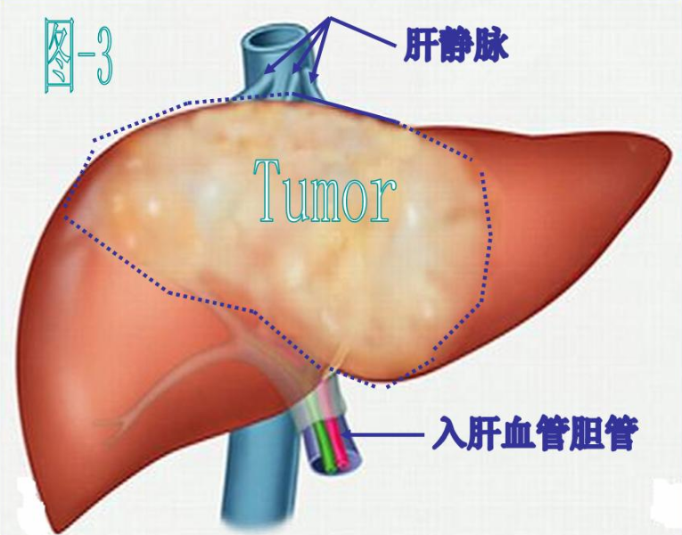 入肝血管和出肝血管示意图:完好的肝脏下静脉可以保证出肝血流畅通