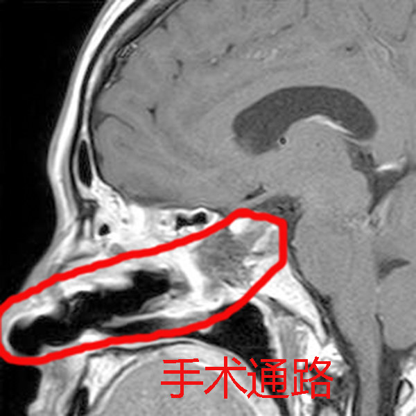 显微镜下经鼻蝶垂体瘤切除