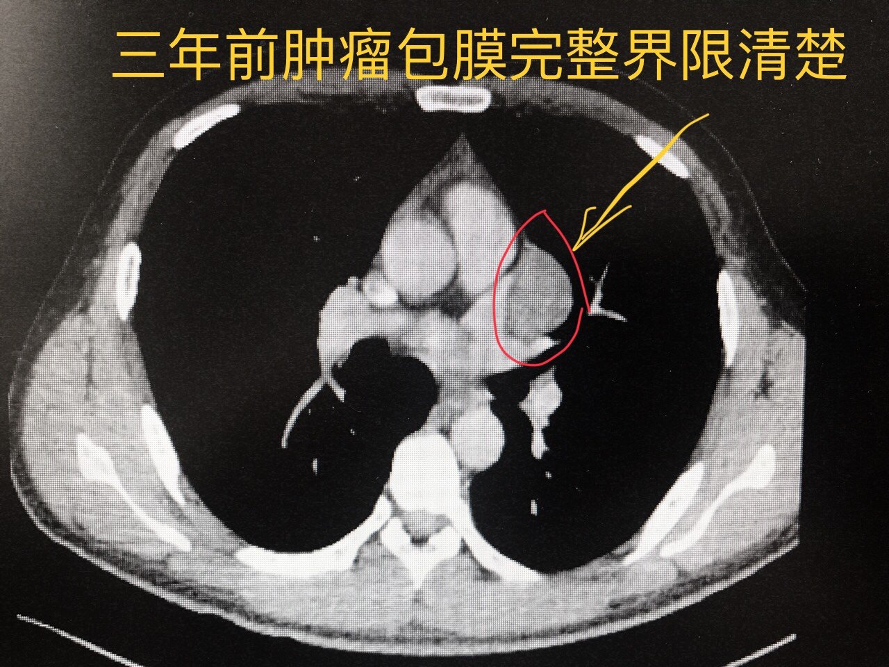 胸腺瘤确诊后要尽早手术切除1例小胸腺瘤三年后突然增大