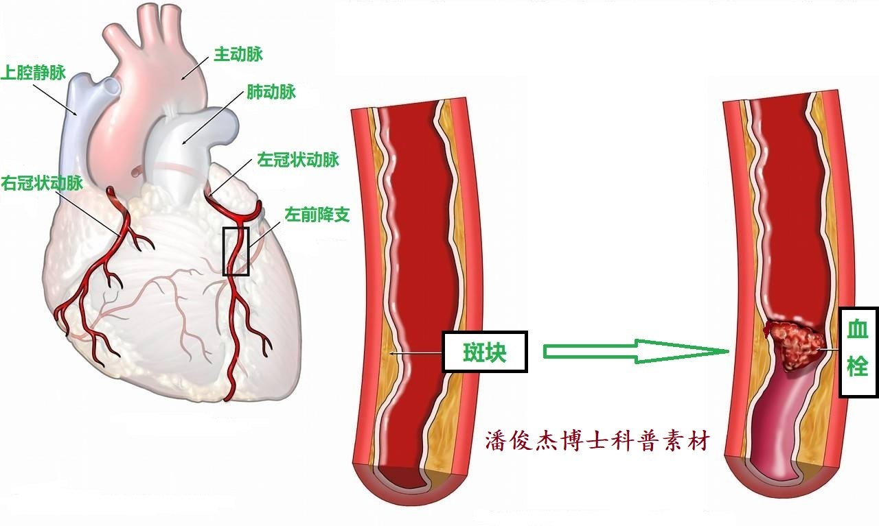 冠状动脉是怎样形成血栓而引起心肌梗死的?