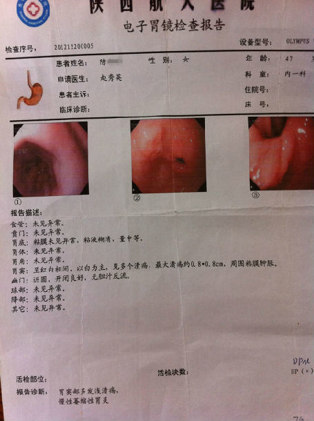 李学武 文章列表    患者9:张**   疗胃镜为"慢性萎缩性 胃炎 伴糜烂