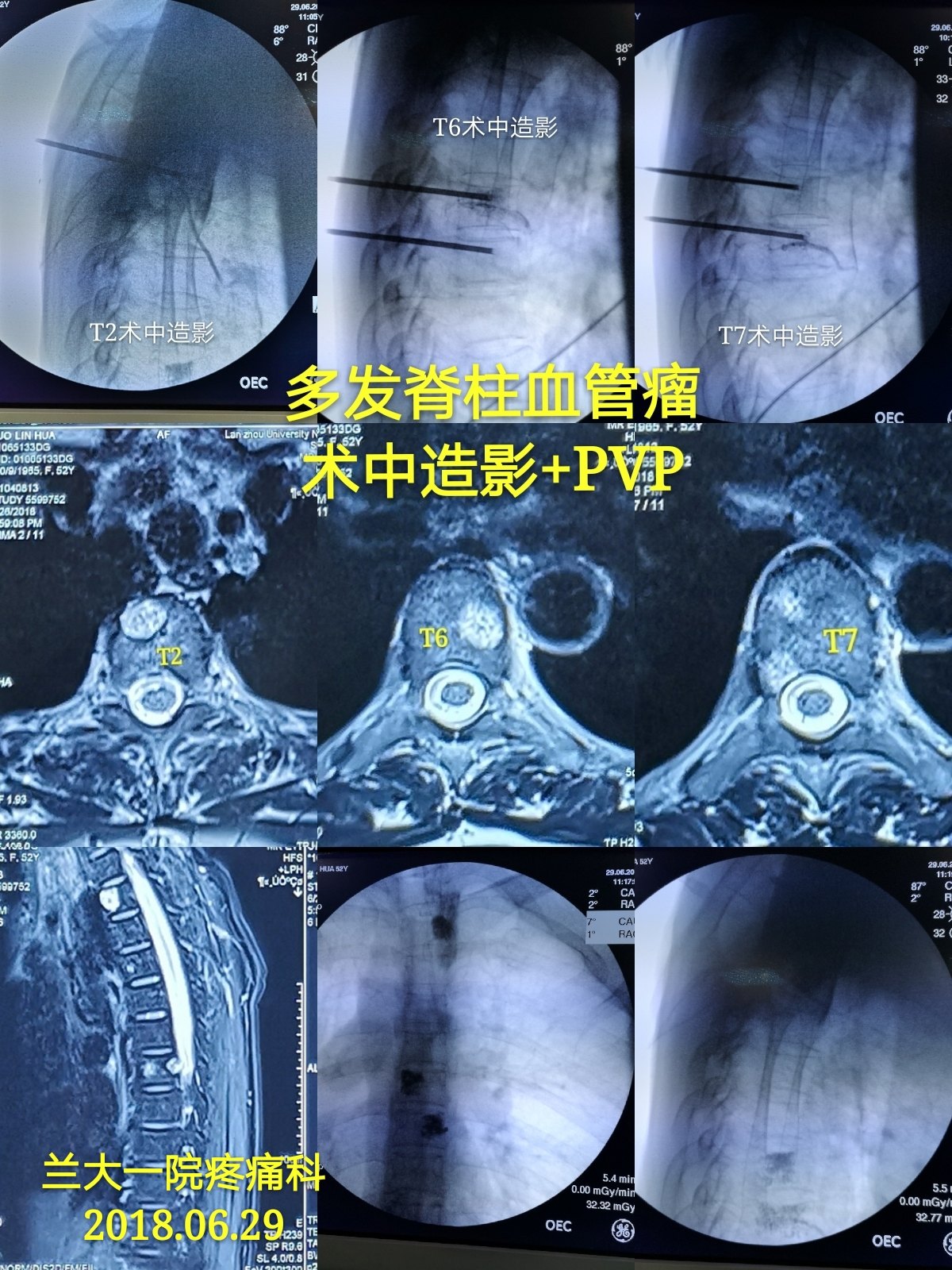 微创手术治疗脊柱血管瘤微创治疗脊柱压缩性骨折脊柱内镜治疗胸椎管
