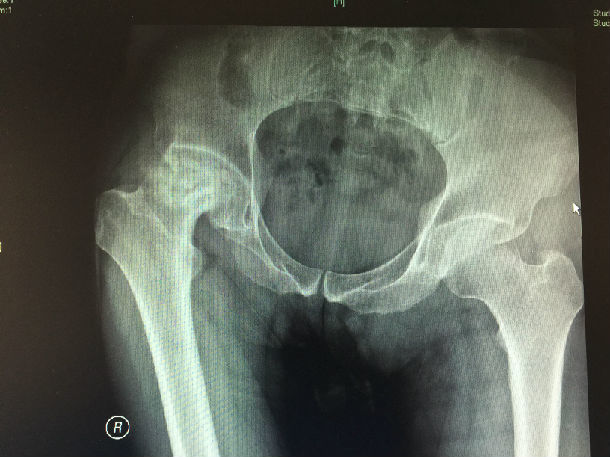 股骨头坏死骨盆倾斜肢体不等长_好大夫在线