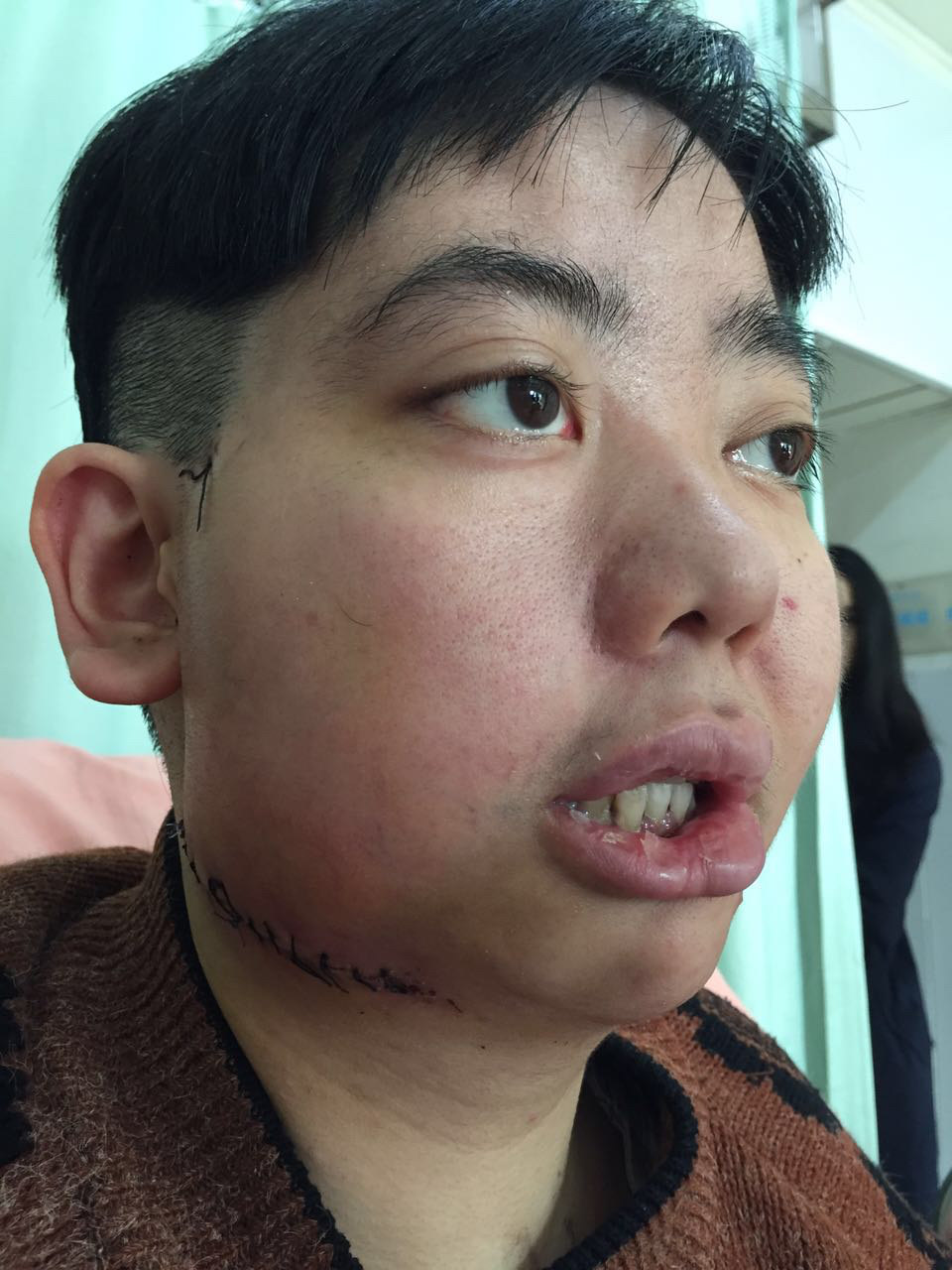 半侧颜面萎缩(romberg氏病)矫正手术治疗