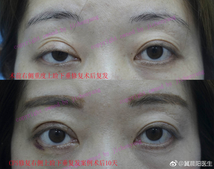 冀晨阳眼部整形双眼皮上睑下垂眼综合眼修复案例
