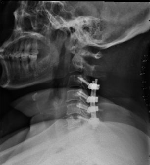 【典型病例】脊髓型颈椎病 - 好大夫在线 ·智