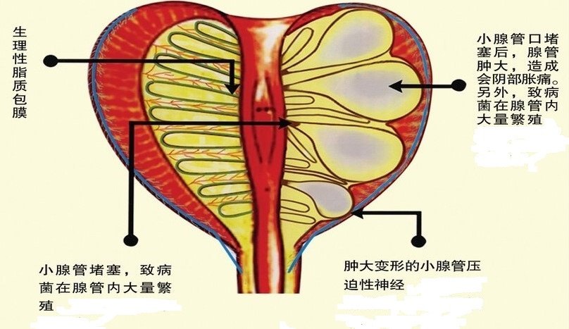 热敷可以改善前列腺及其周围组织的血运,也有助于慢性前列腺炎不适