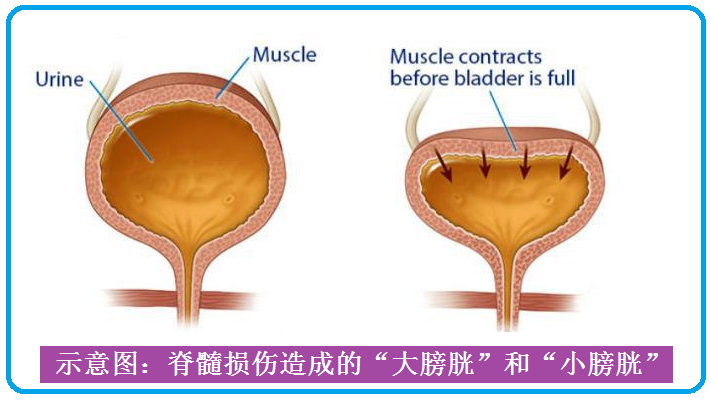 注射肉毒素扩大膀胱 清洁导尿 适应症:脊髓损伤后出现 小膀胱"和排尿