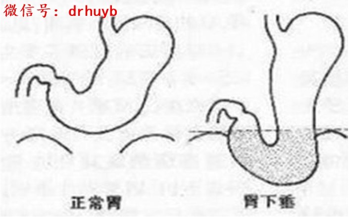 如何诊断胃下垂