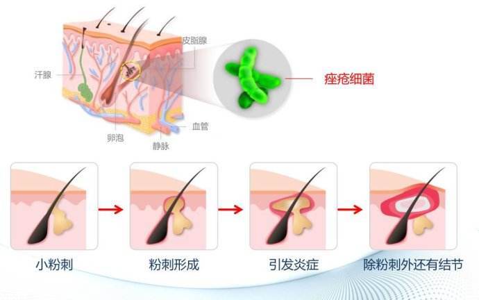 为什么会得痤疮 好大夫在线