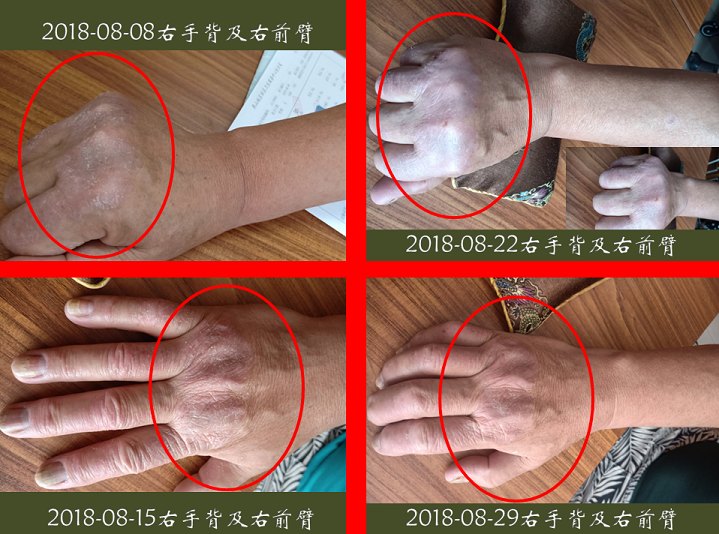 湿毒泛溢—皮肤病治验案例3则(附图片)