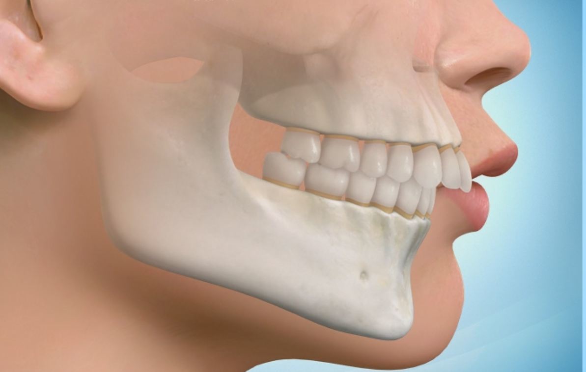 牙颌畸形_牙颌畸形疾病介绍 好大夫在线
