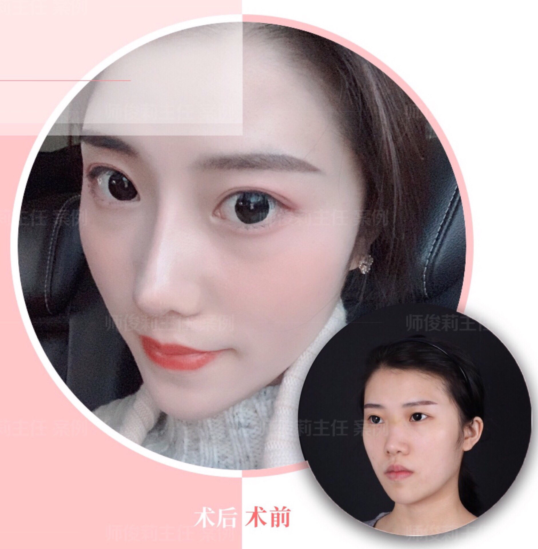 师姐细说"妈生款"美鼻之形态自然