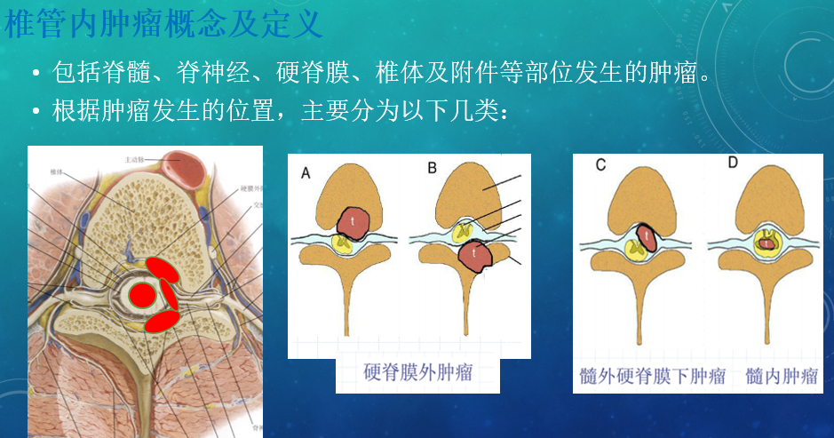 误以为腰椎间盘突出小心椎管内肿瘤在作祟