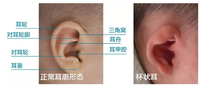 杯状耳的治疗与注意事项