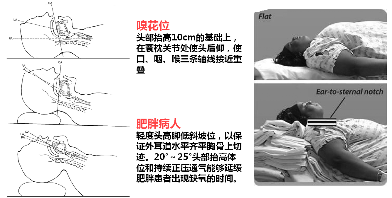 mallampati分级Ⅲ或Ⅳ级,下颌前伸能力受限,甲颏距离过短( 6 cm)是