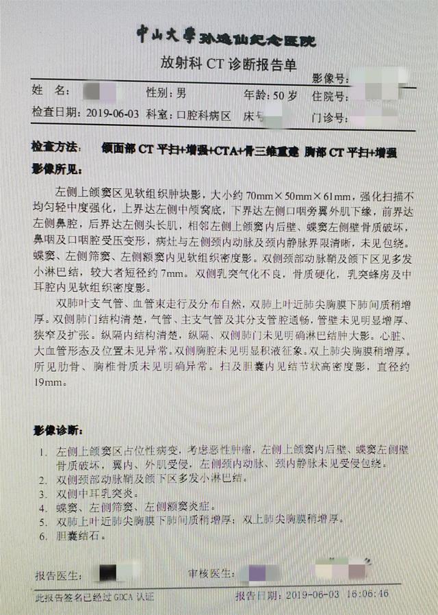 一例鼻咽癌放疗诱导的左上颌颅底骨肉瘤,较为棘手的病例