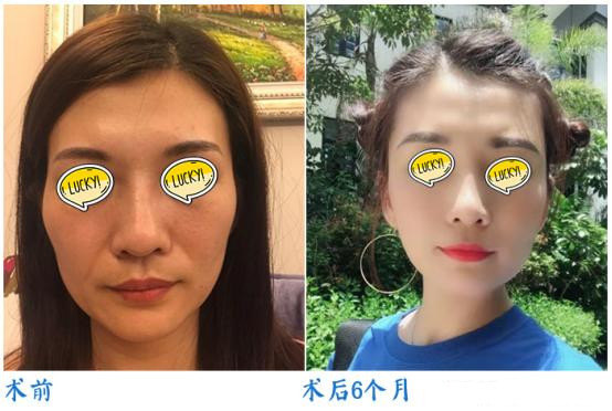 面部松弛下垂最有效的方法是什么脸上没肉可以做吗多久能恢复自然