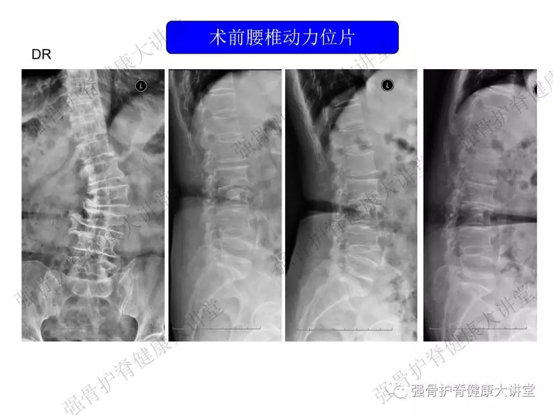 腰椎管狭窄症(l1-l5椎间盘突出并相应节段狭窄