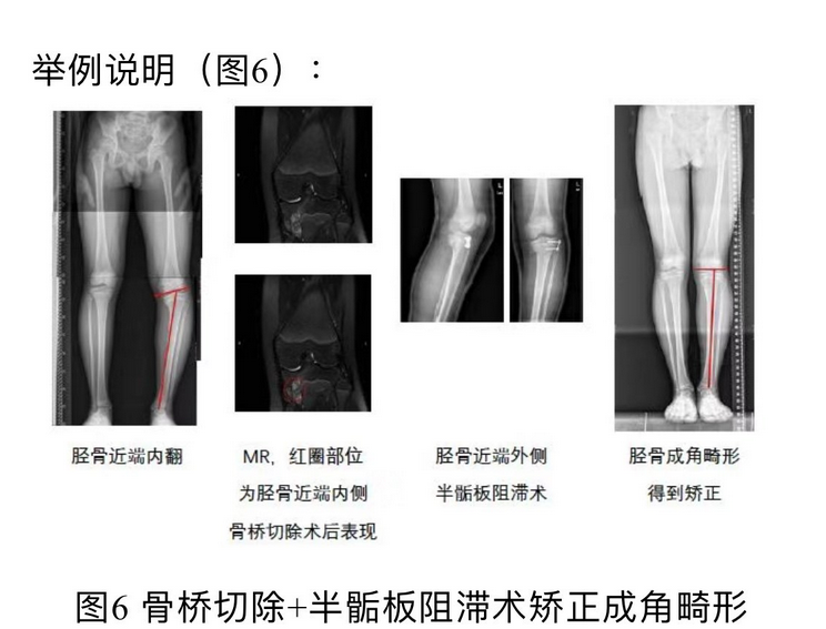 什么是"骺板骨桥"?