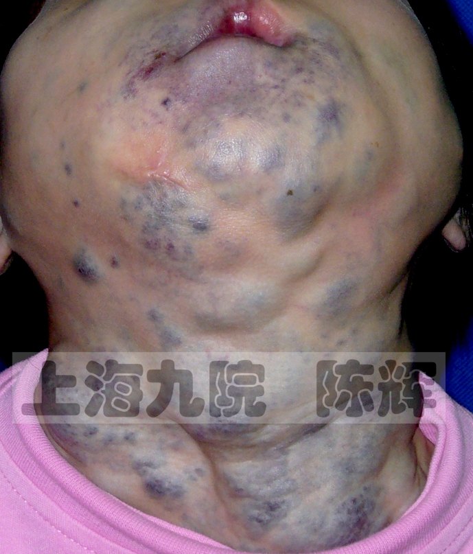 静脉畸形海绵状血管瘤十六问多图详解