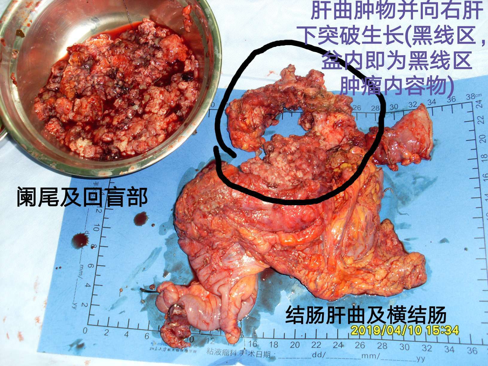 病例40结肠肝曲粘液腺癌突破肠管向外生长