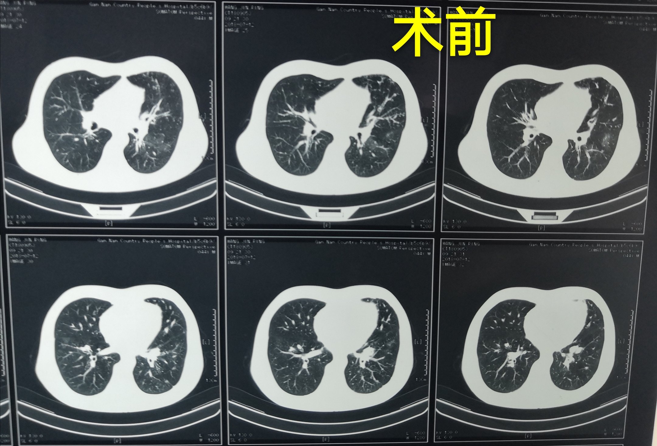 哈医大二院胸外科经典病例之支气管扩张