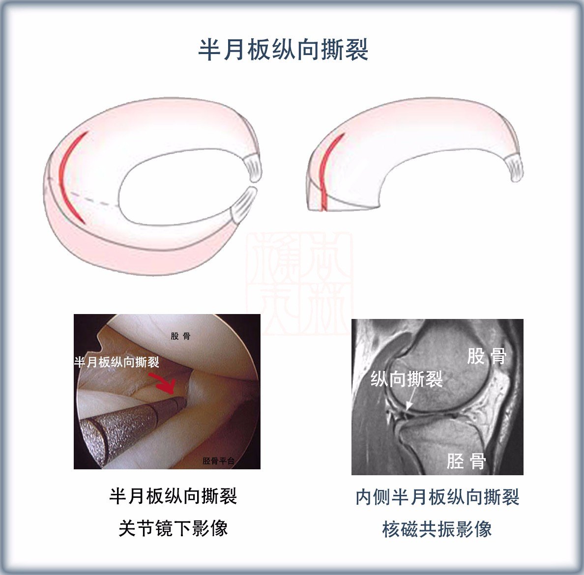 半月板损伤的最好治疗方法?哪种修复治疗方法好?效果如何?(含录像)