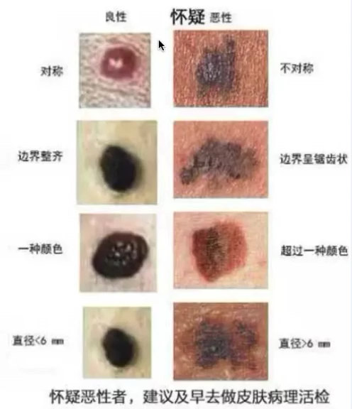 如何肉眼直观判断痣有没有恶变