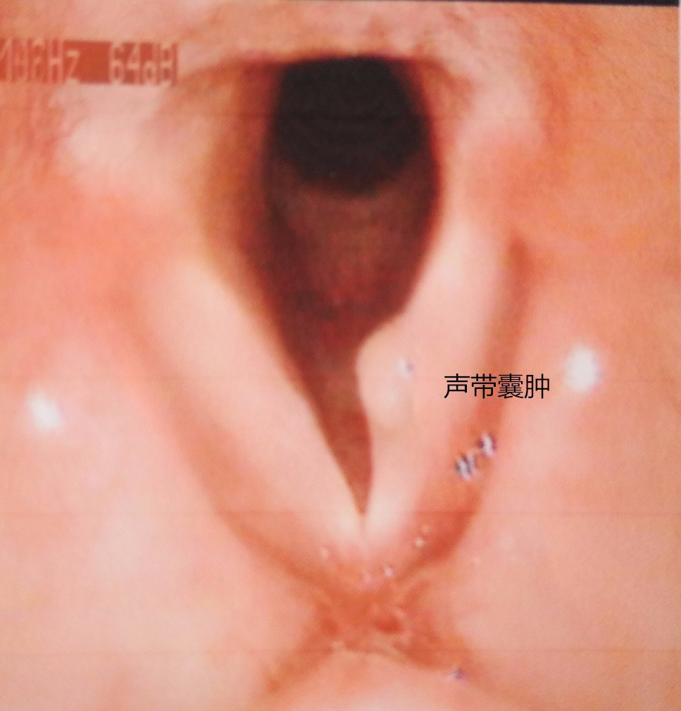声带囊肿怎么办