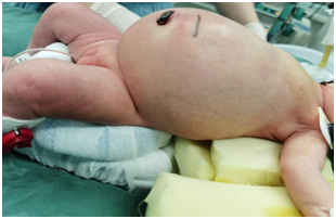 从产前诊断到出生后及时手术,成功为1例患有巨大骶尾部畸胎瘤新生儿