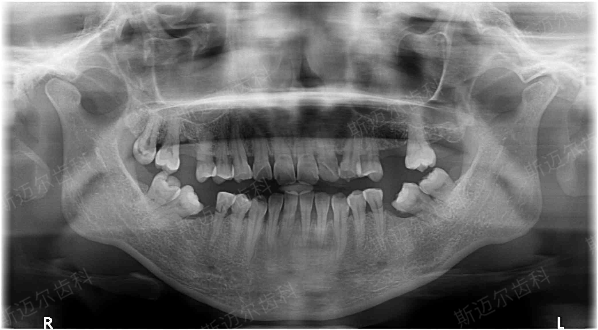 牙齿矫正前拍的x光片都有什么作用