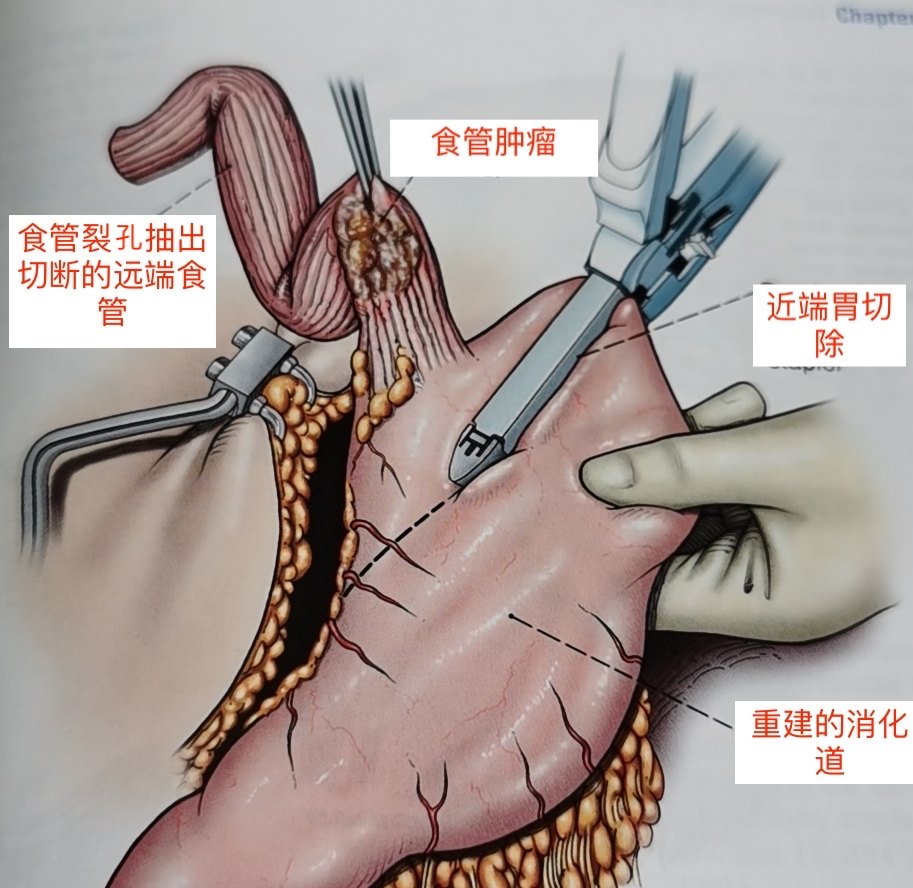the与tte手术图示及如何选择?
