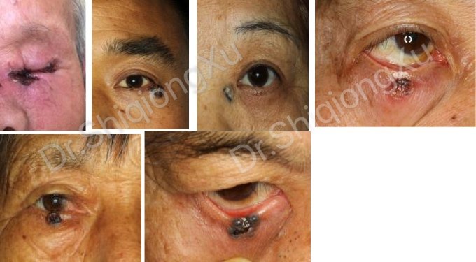 眼睑肿瘤系列之眼睑恶性肿瘤常见的有哪几种看图鉴别你是哪一种