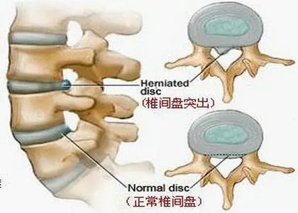 腰椎间盘突出压迫马尾神经出现马尾神经综合征危险