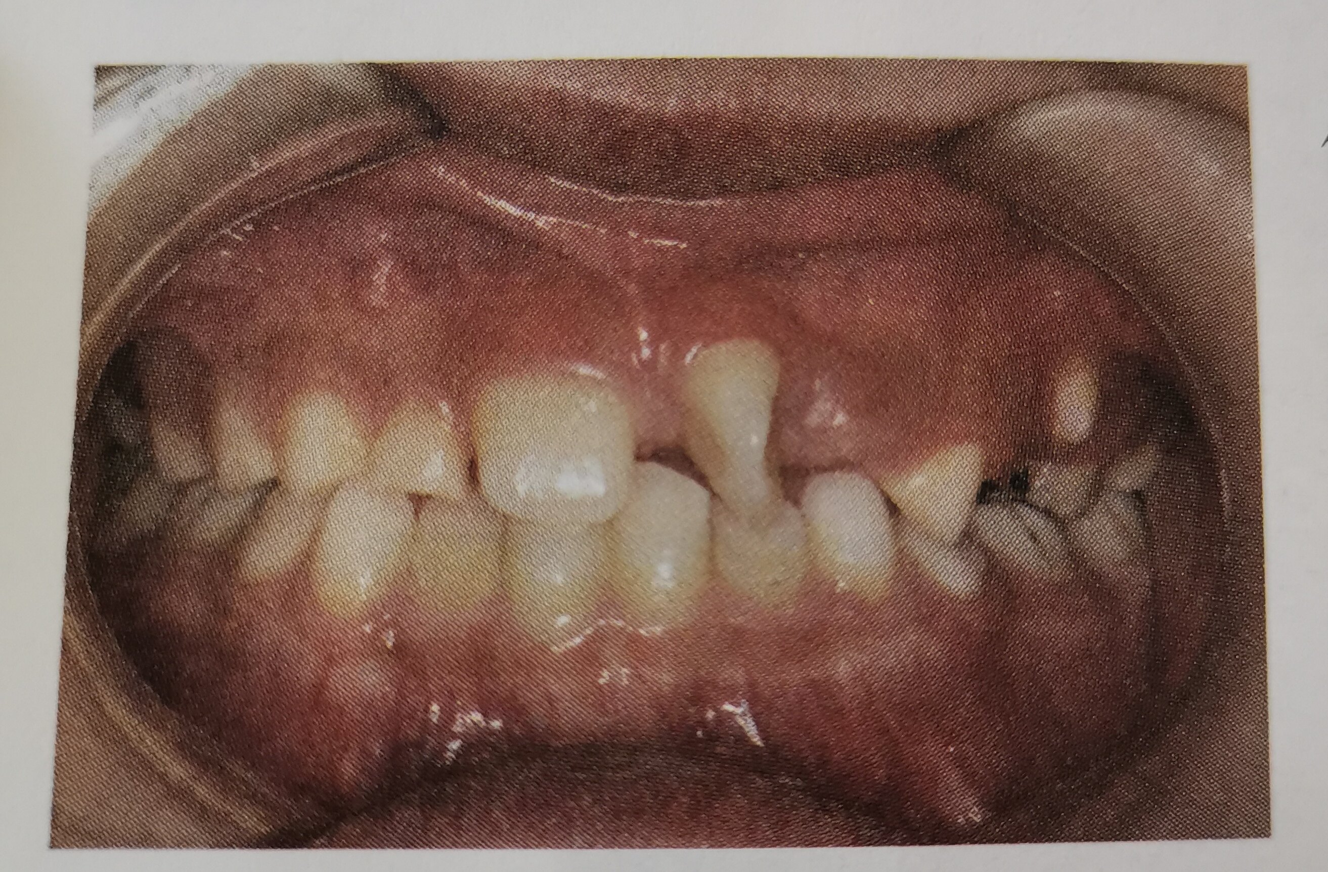 儿童牙颌畸形