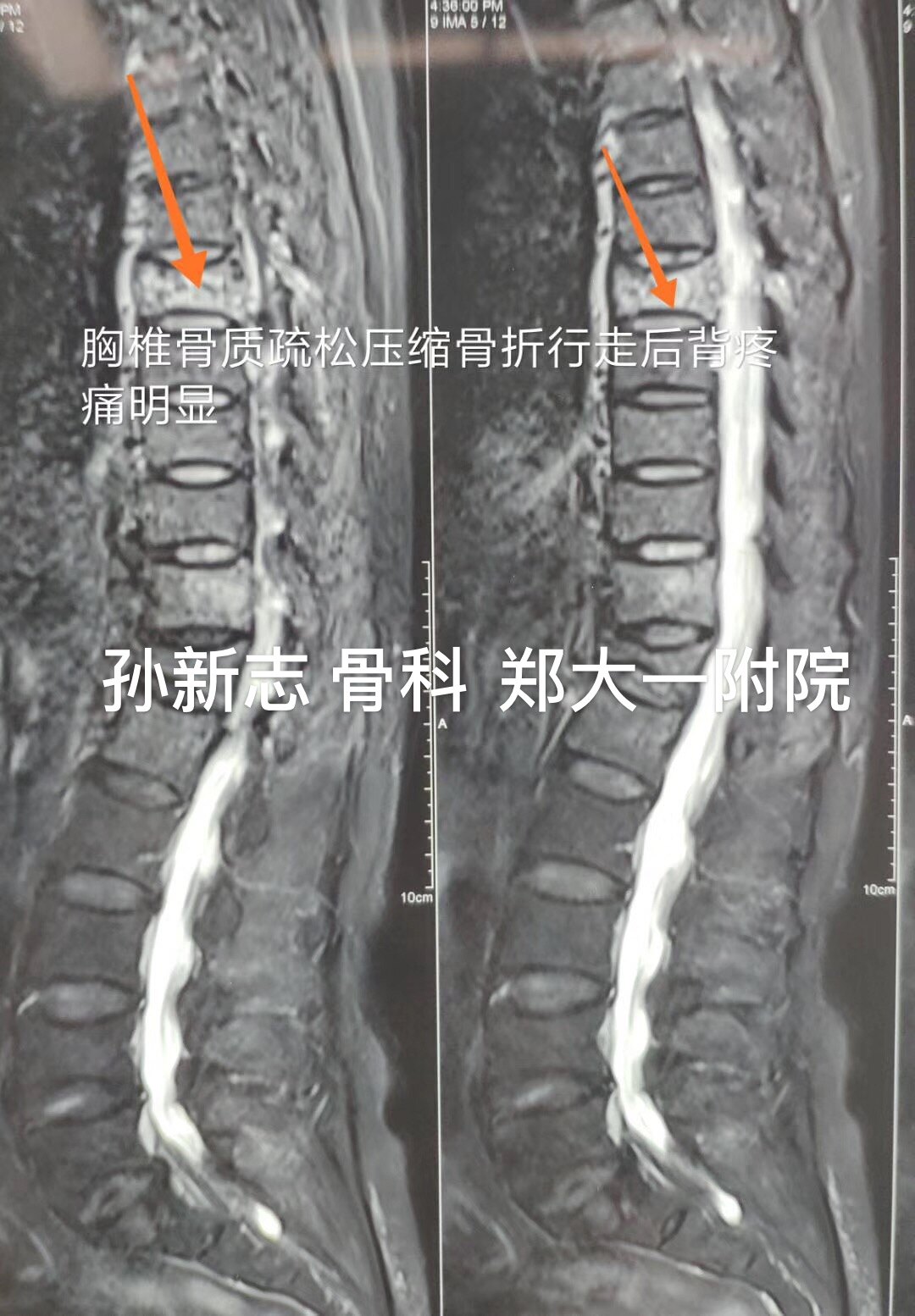 孙新志教授:微创治疗胸椎压缩性骨折病例66