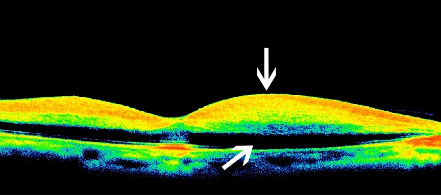oct:视网膜神经纤维层呈红色,黄色高反射(中箭头),其下方水肿,呈遮蔽