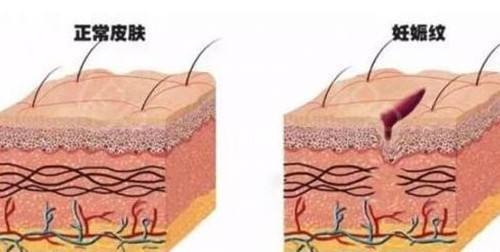 就像一跟橡皮筋,一直被拉,拉到撑不住,就容易断裂.