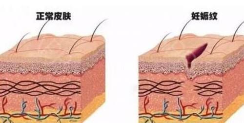 关于妊娠纹预防与治疗——妊娠纹究竟应该如何去除?