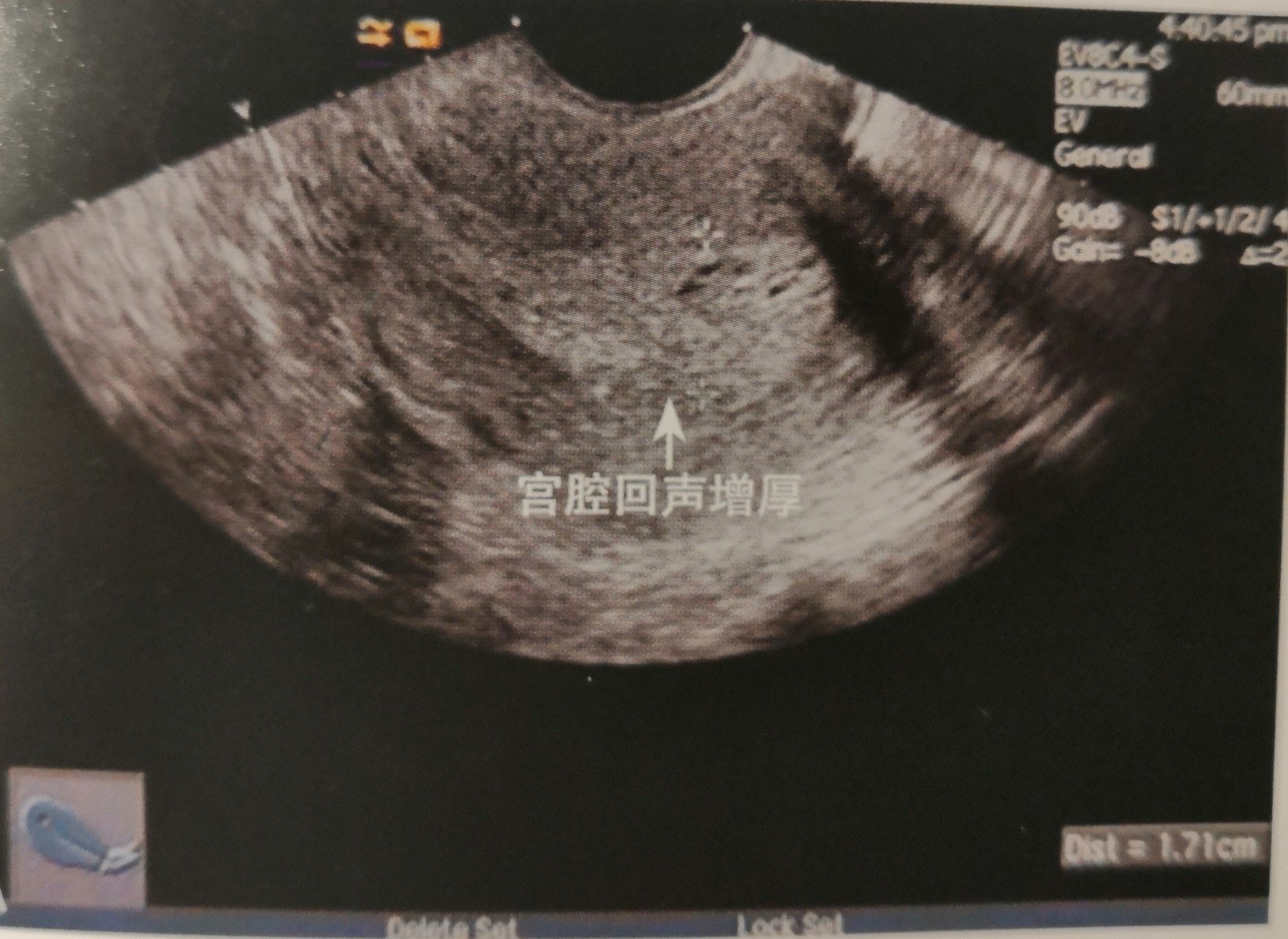 经阴道超声检查:宫腔回声明显增厚,内见微小无回声区.