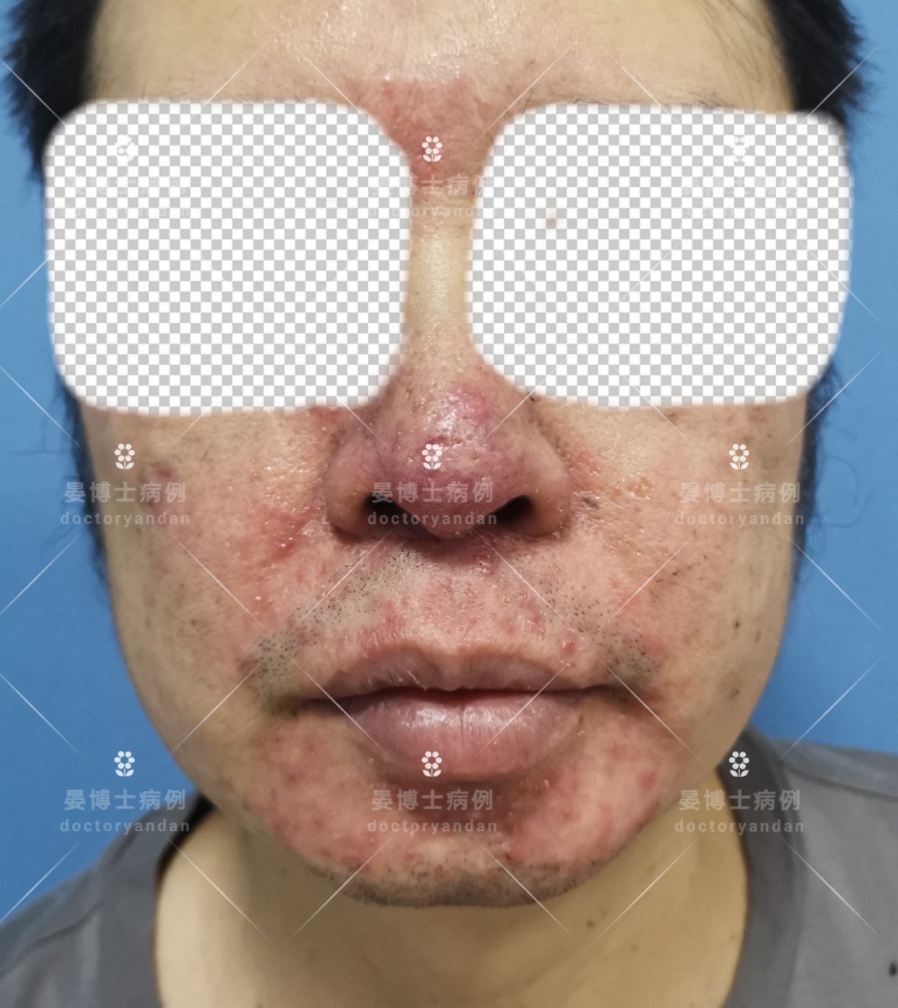 青少年长的青春痘,酒糟鼻的表现开始是以鼻子为中心发红,然后出现红斑