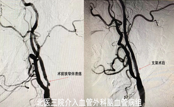 长了颈动脉斑块会中风么?