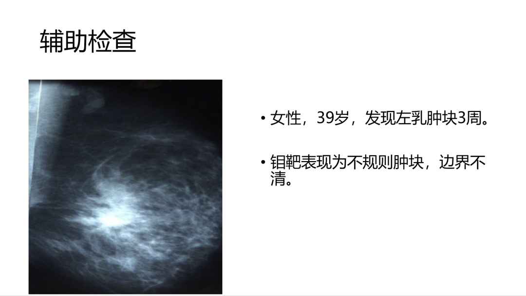 精准医学肉芽肿性乳腺炎      对于疑诊肉芽肿性乳腺炎,乳腺超声是