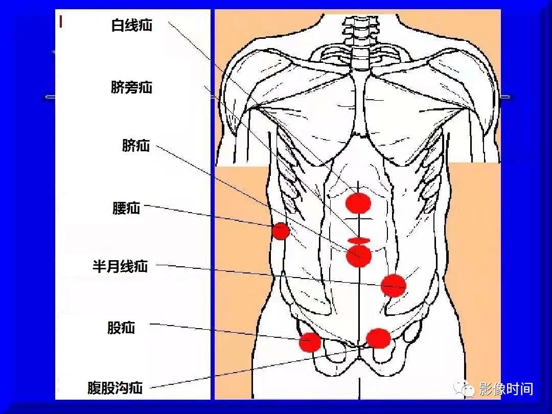 常见腹壁腹外疝位置一般根据疝突出位置,物理诊断即可,可进一步ct影像