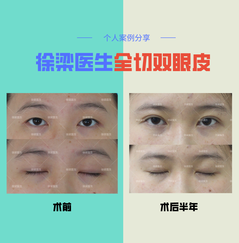 双眼皮精品案例—眼皮松弛改如何改善?_双眼皮手术_双