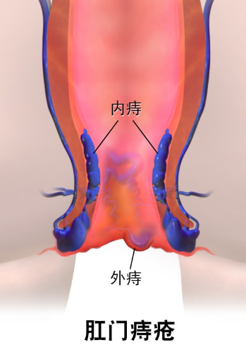 大便有血,是痔疮还是肛裂?