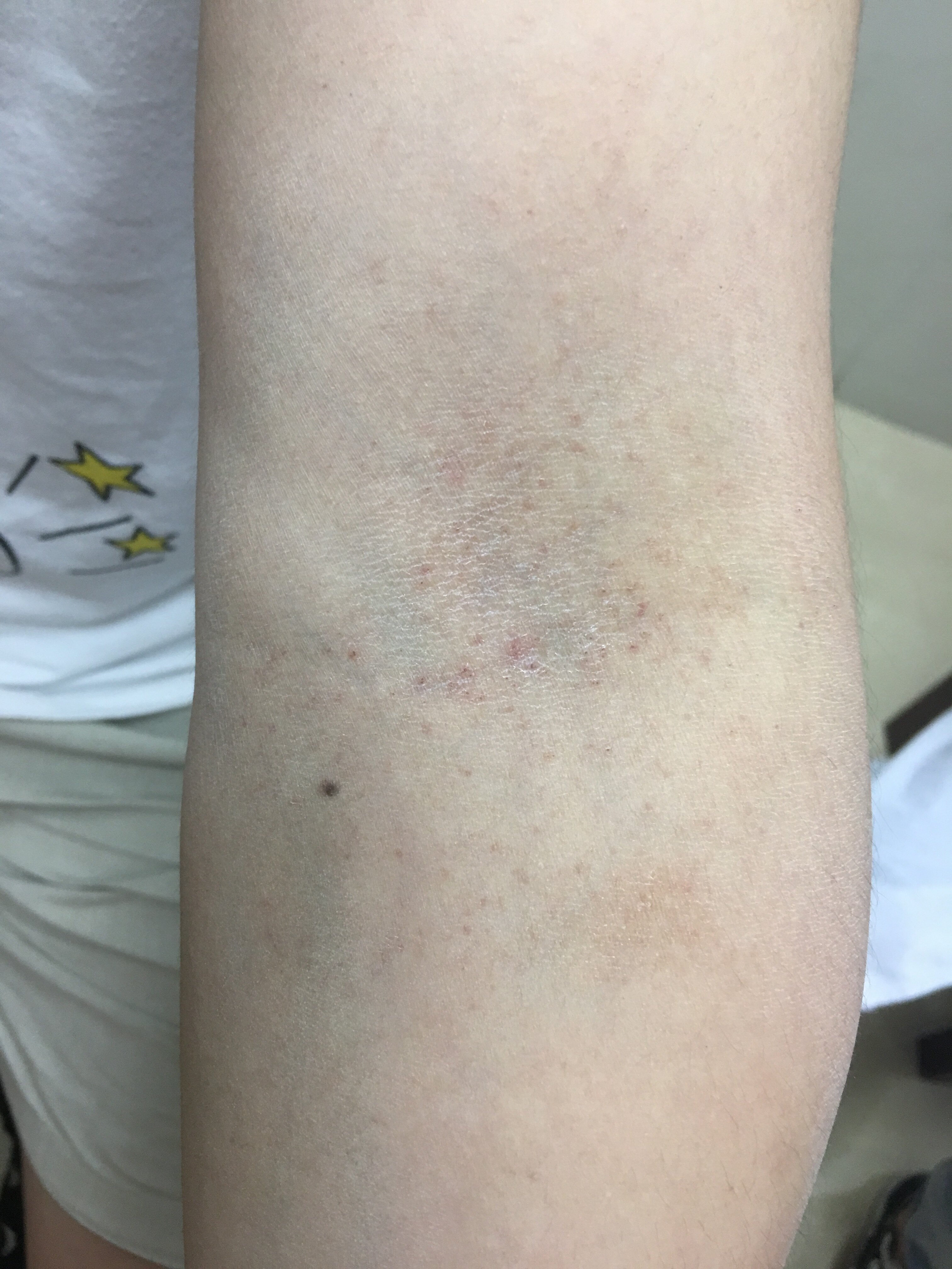 怎么认识特应性皮炎?