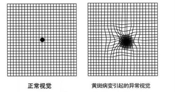 黄斑裂孔知多少